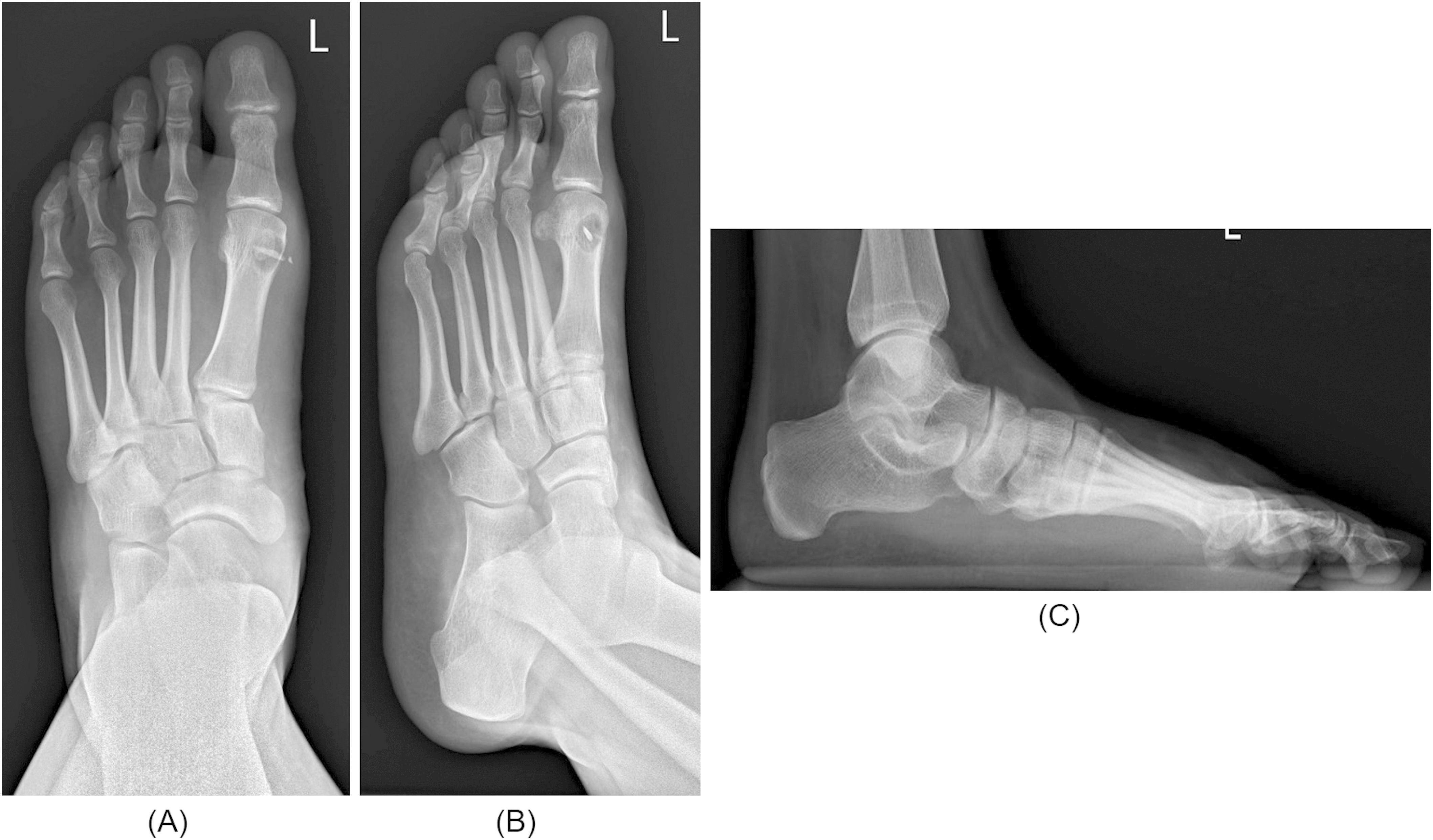 JBJS: Osteolytic Lesion of the First Metatarsal After Catfish Spine Injury