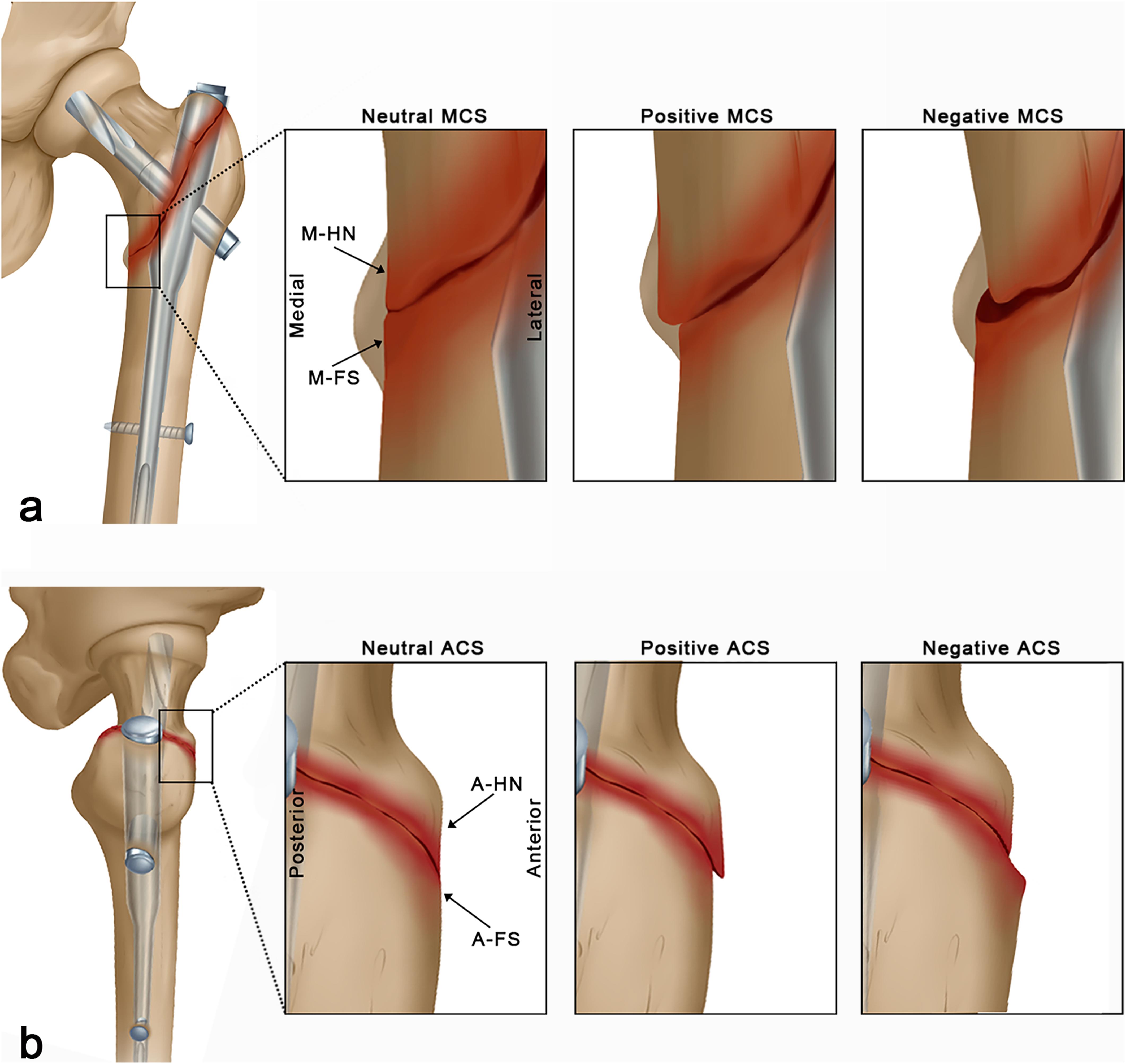JBJS: Anteromedial Cortical Support in Reduction of Trochanteric 